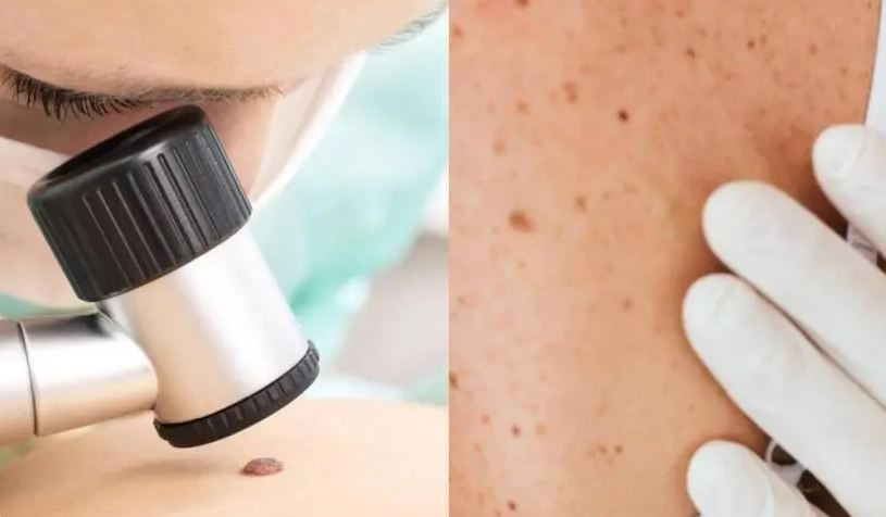 cancer-de-Piel-Notisalud